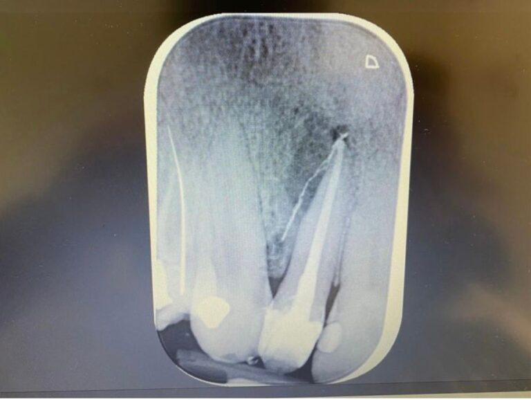 Endodonzia dopo