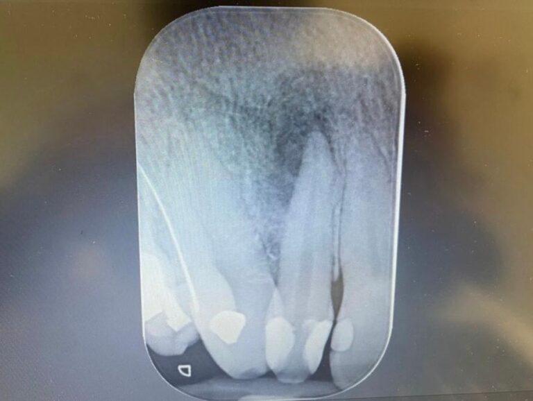 Endodonzia prima