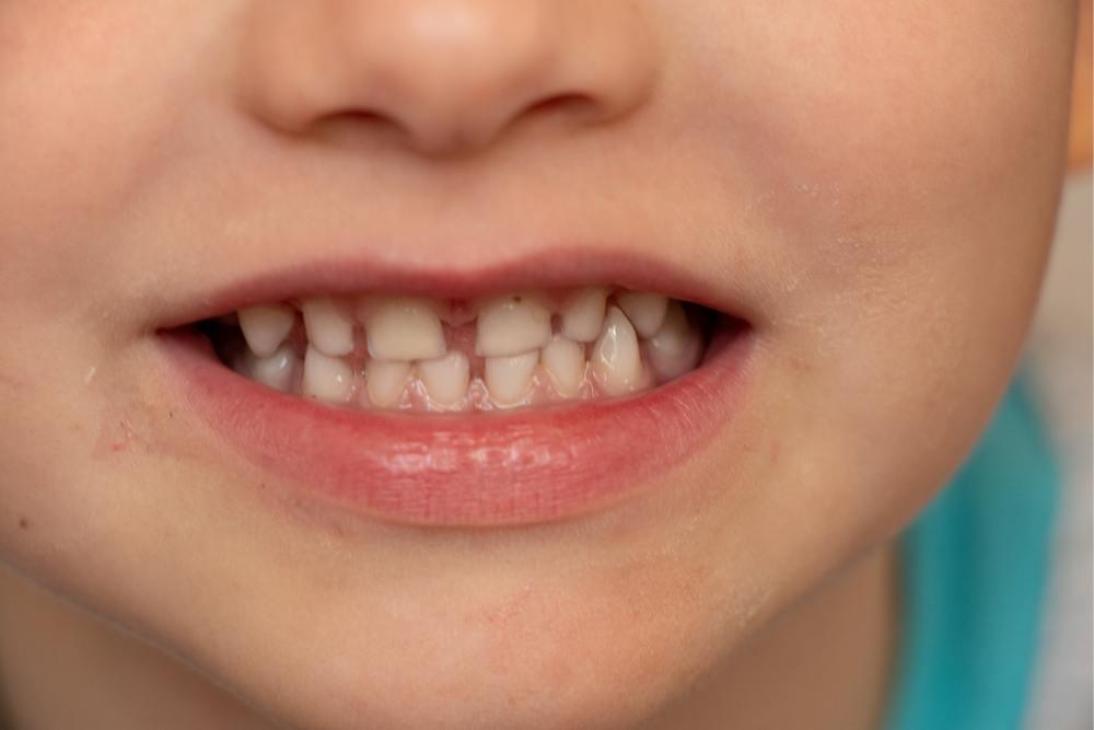 Ciuccio e problemi dentali